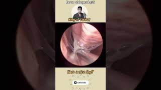 귀지형 콧물 부비동염 축농증 비염 코청소 이비인후과 rhinorrhea rhinitis sinusitis asmr ENT ENTdoctor [upl. by Flatto]