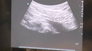 Trigger Point Injections  Ultrasound Guided [upl. by Carly847]