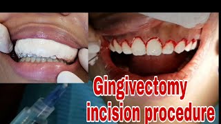 Gingivectomy incision procedure  gum cutting [upl. by Navak675]