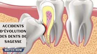 Accidents dévolution des dents de sagesse [upl. by Akimehs168]