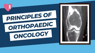 Principles of Orthopaedic Oncology and Bone Tumours for the FRCS Ortho Exam [upl. by Enahsed102]