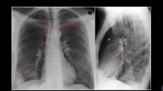 Tromboembolismo Pulmonar [upl. by Bryon455]