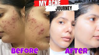 My acne journey that changes my life  How i cleared my skin in 4 months [upl. by Viridissa]