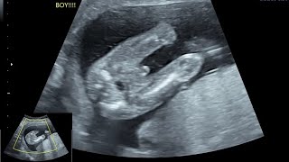 PREGNANCY ULTRASOUND REPORT IN HINDIBPDHCFLAC FETAL BIOMETRYUSG REPORT समझे हिंदी मैं [upl. by Bolten]