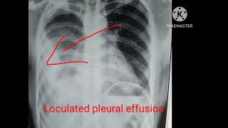 Loculated pleural effusion [upl. by Tselec]