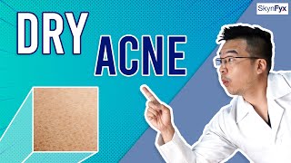 How To Treat Dry Skin  Acne Dry Acne  5 Tips To Follow [upl. by Anreval]