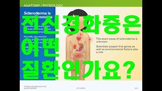 전신경화증과 사례Systemic Sclerosis [upl. by Rheingold]