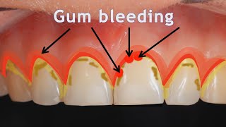 Gums Gum Disease Gingivitis and Periodontitis [upl. by Anerul]