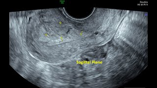 Retained Products of Conception  Ultrasound [upl. by Laeahcim]