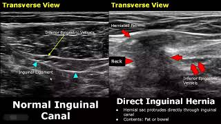 Inguinal hernia exercises Do it right  Arogya physiotips [upl. by Landahl]