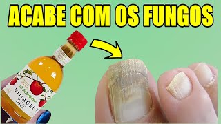 EM APENAS 3 DIAS CURE OS FUNGOS DAS UNHAS DOS PÉS EM CASA  MELHOR RECEITA PARA FUNGOS NAS UNHAS [upl. by Nerraj292]