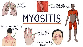 Understanding Myositis Polymyositis and Dermatomyositis [upl. by Aisats763]