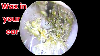 Ear picking  Cleaning earwax asmr ear cleaning wax in your ear Ear health ear piercing cleaning [upl. by Verile]