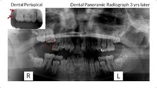 The Video Atlas  Cystic Ameloblastic Fibroma [upl. by Adlanor]