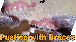 Pustiso with Braces and Acrylic Dentures [upl. by Spatola735]