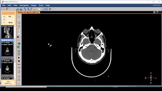 DICOM viewer software the easiest way to review CTs and MRIs on your PC [upl. by Ollecram]