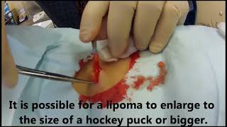 Office Procedure Lipoma Removal [upl. by Eelarat164]