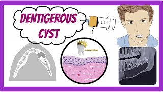 ORAL PATHOLOGY  DENTIGEROUS CYST [upl. by Htenywg722]