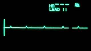 Primary Ventricular Standstill P wave Asystole [upl. by Tudor954]