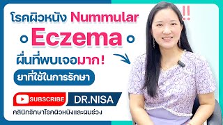 Nummular eczema ผื่นที่พบเจอมาก [upl. by Ramor]