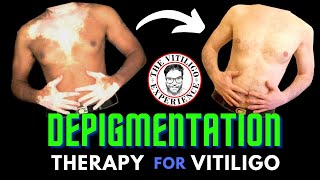 Depigmentation  A Vitiligo treatment which works and is permanent [upl. by Ecallaw701]