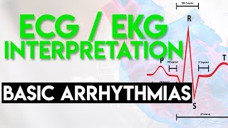 Basic Arrhythmias  Sinus Brady Tachy Premature Beats  ECG EKG Interpretation Part 3 [upl. by Aloivaf]