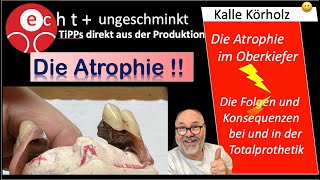 Das Phänomen der Atrophie in der Totalprothetik [upl. by Einnaej869]