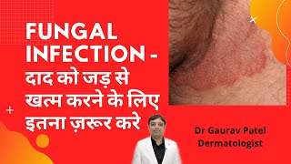 Fungal infection दाद को जड़ से मिटाने के लिए क्या करें Dr Gaurav पटेल  Dermatologist [upl. by Blithe]