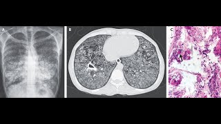 Pulmonale alveoläre Microlithiasis kompliziert durch Tuberkulose [upl. by Schlenger]