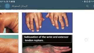 Rheumatology  Rheumatoid arthritis [upl. by Nnahs]