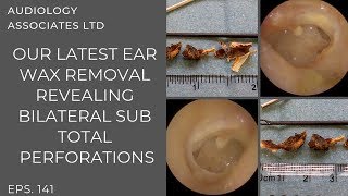 EAR WAX REMOVAL REVEALING BILATERAL SUB TOTAL PERFORATIONS  EP 141 [upl. by Ingmar]