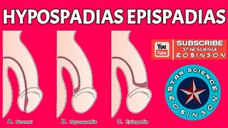 HYPOSPADIAS EPISPADIAS IN STAR SCIENCE ROBINSON [upl. by Nehemiah]