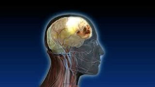 What is a Subdural Hematoma or Blood on the Brain [upl. by Modestine389]