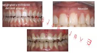 TEORICO RELACION DE LA PROSTODONCIA CON LA PERIODONCIA [upl. by Eetsud314]