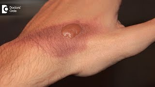 How to treat a burn blister at home Tips to avoid burn scar  Dr Pavan Murdeshwar [upl. by Gem]