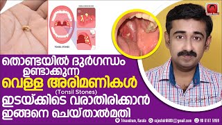 തൊണ്ടയിൽ നിന്നും ദുർഗന്ധമുള്ള വെള്ള അരിമണികൾ Tonsil Stones  വരാതിരിക്കാൻ ഇങ്ങനെ ചെയ്‌താൽ മതി [upl. by Peterson]