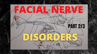 030 Facial Nerve Disorders Part 23  Fracture temporal bone topodiagnostic tests [upl. by Mani]