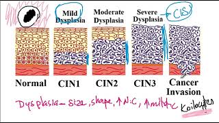 USMLE ACE Video 88 Human Papillomavirus HPV and Cervical Cancer Risk Factors [upl. by Scott]