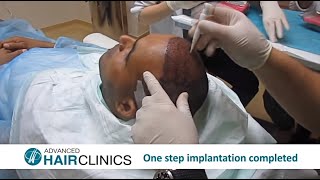 FUE Hair Transplantation StepbyStep by Dr Anastasios Vekris [upl. by Dael]