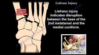 Lisfranc Injury  Everything You Need To Know  Dr Nabil Ebraheim [upl. by Argus]