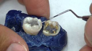 Complex Amalgam Retention [upl. by Sublett]