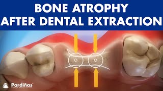 Bone atrophy after tooth extraction © [upl. by Gnort]