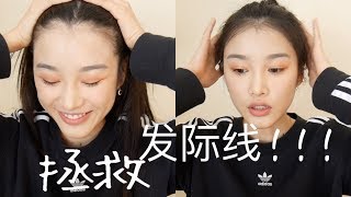 Receding Hairline  快速拯救你髮際線的方法 [upl. by Herzberg]