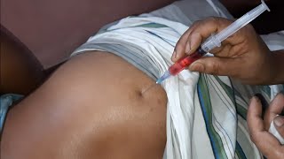 ivf buttock injection video Neuralgin Intramuscular injection buttock injection push 24 Ep 31 [upl. by Uliram]