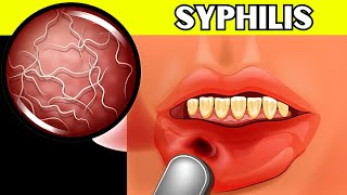 Syphilis  Causes Signs amp Symptoms Pathogenesis Diagnosis And Treatment [upl. by Inafetse328]