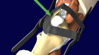 PTO Patellar Tracking Orthosis Knee Brace Directions and Application [upl. by Klarrisa372]