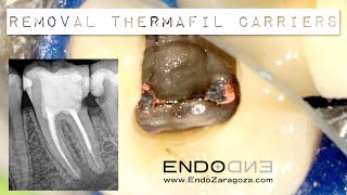 REMOVAL THERMAFIL CARRIERS ENDODONTIC RETREATMENT [upl. by Steffin]