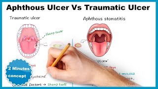 Aphthous ulcerstomatitis Vs Traumatic ulcer [upl. by Uaerraj]