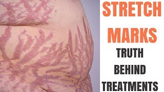 Best STRETCH MARK removal [upl. by Gerik939]