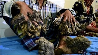 Bangladeshs Tree Man has surgery to remove warts [upl. by Nolyd]